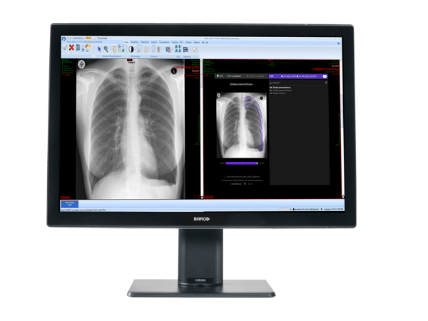 Annalise CXR output