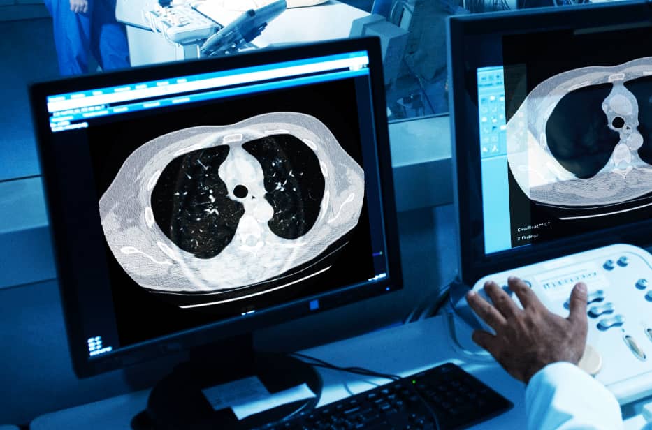 Pulmonary Nodule Detection | ClearRead CT