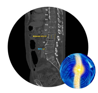 Nanox-Health-OST-Bone