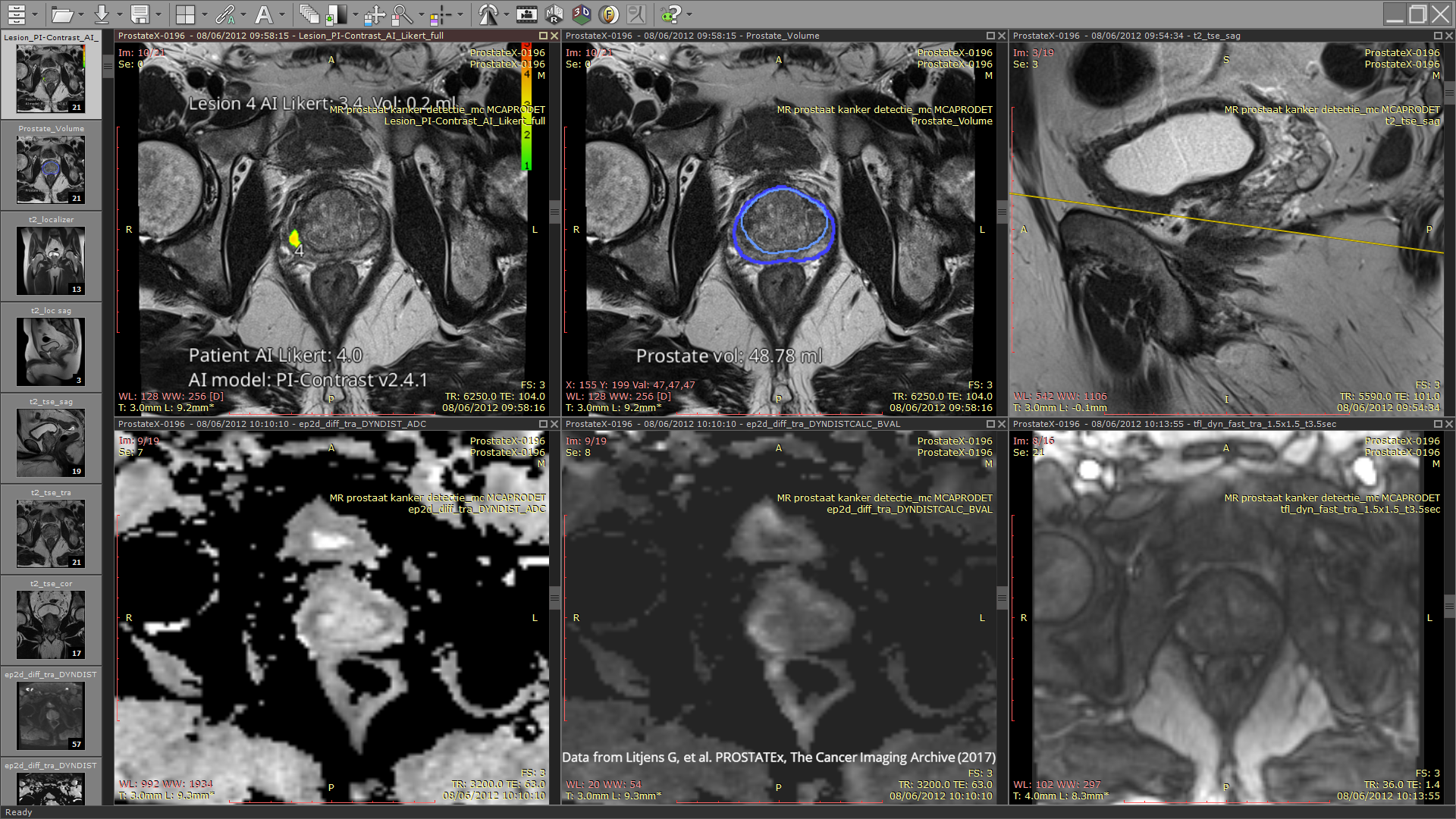ProstateX-0196-lesion4-unreported-pirads4-1