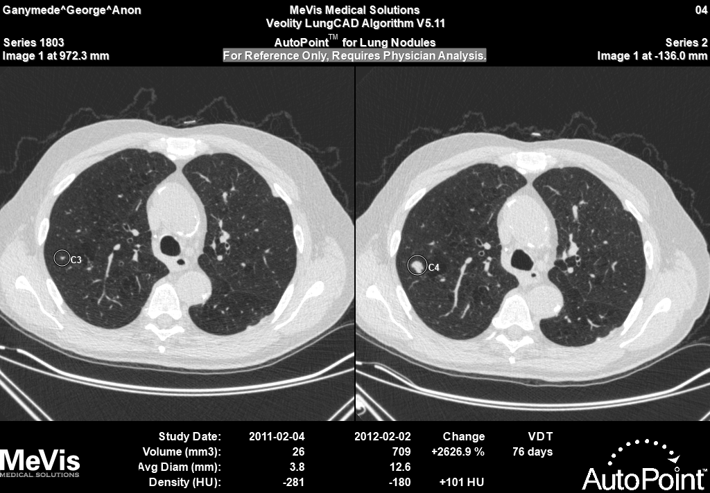Veolity_LungCAD_Lung nodule temporal comparison key image with CAD mark (solid nodule)