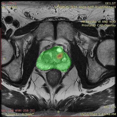 Image from ProstatID application