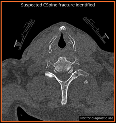 Detection of Cervical Spine Fractures | CINA CSpine
