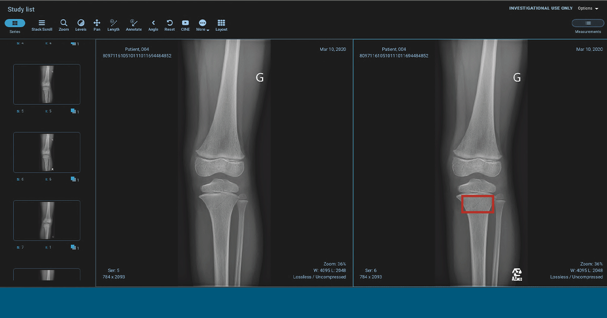 Fast and Comprehensive Fracture Detection | AZmed Solutions